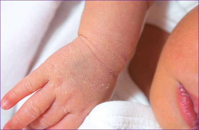 Tør hud hos baby: 20 årsager og 10 retsmidler
