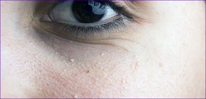 Skimmelsvamp i ansigtet og under øjnene - hvordan man slipper af med det - kommentarer fra en dermatolog og en gennemgang af 6 hudplejeprodukter